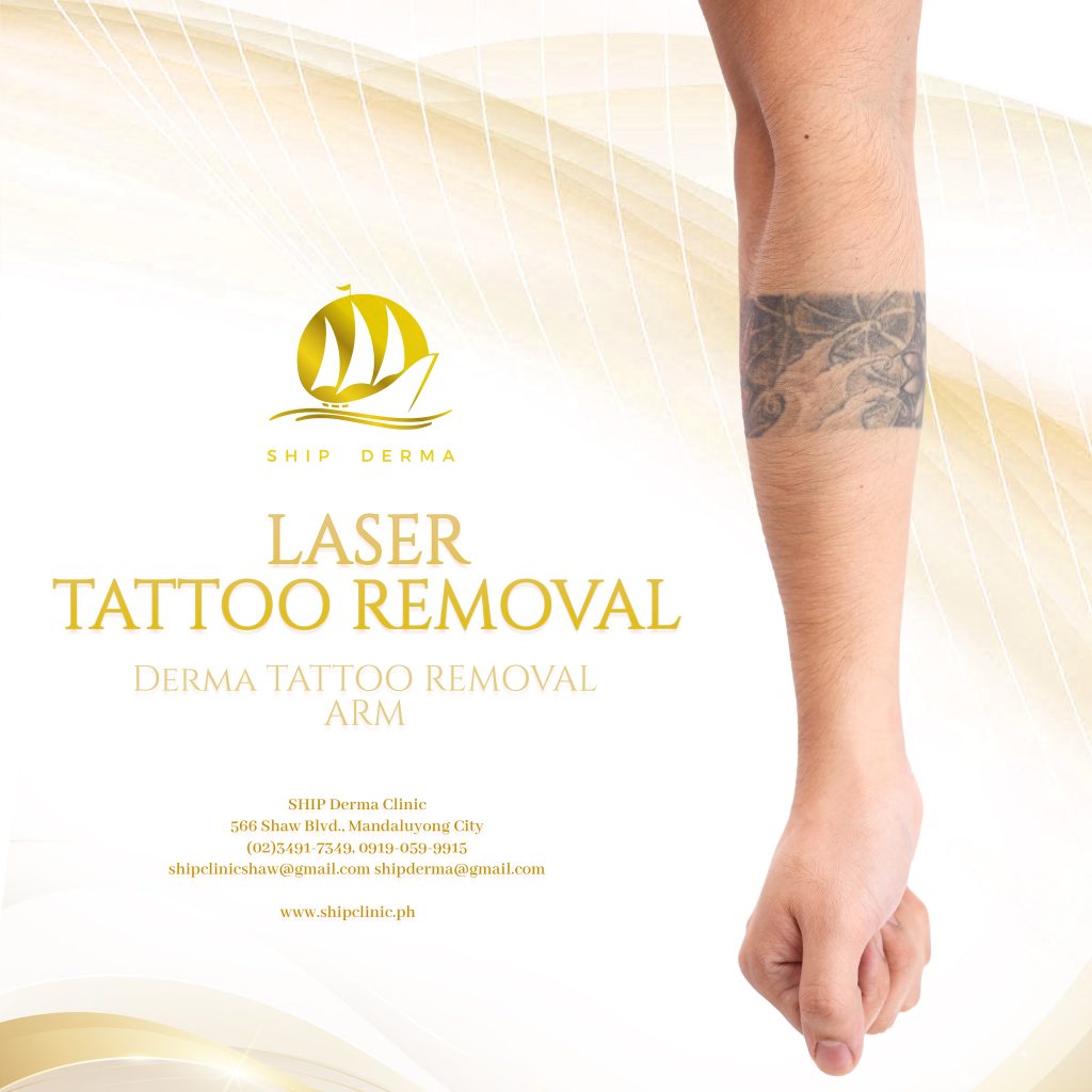 LASER TATTOO REMOVAL - M